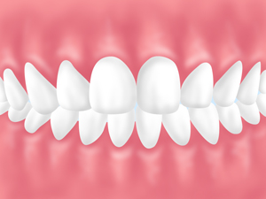 「歯の後戻り」が起こる理由