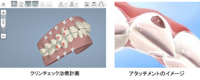インビザラインのアタッチメントとは？