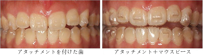 インビザラインのアタッチメントとは？
