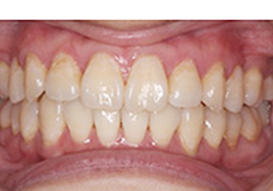 マウスピース型矯正歯科装置（インビザライン）の治療例