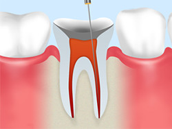 根管治療