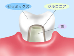 セラミックスクラウン