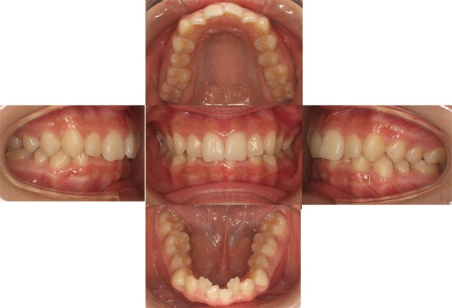 列 ピース マウス 歯 矯正 前歯の出っ歯はマウスピース矯正で治せる？