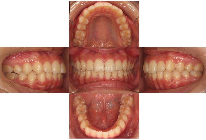 治療期間：9ヶ月（マウスピース25枚）After