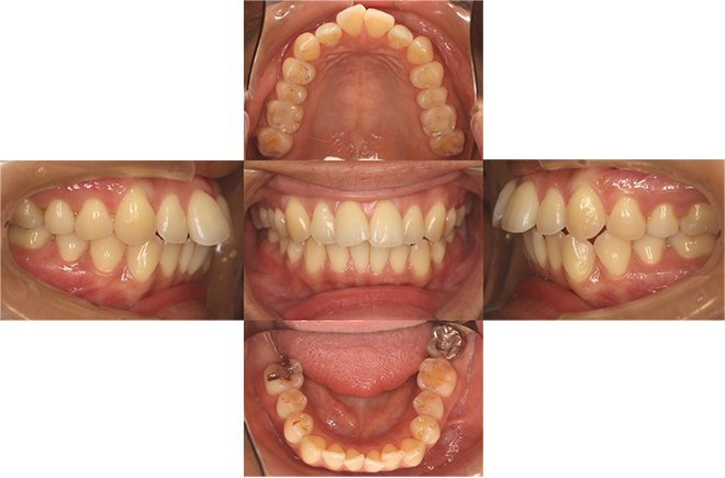 治療期間：7ヶ月（マウスピース22枚） Before