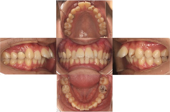 治療期間：11ヶ月（マウスピース38枚） Before