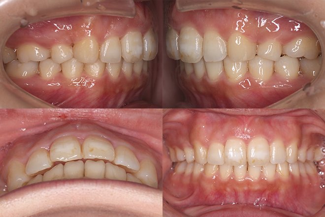 上顎のみ2本抜歯 治療期間11カ月 追加アライナー無し After