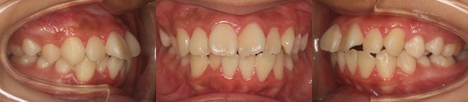 上下第一小臼歯4本抜歯 治療期間11カ月 追加アライナー無し 治療前