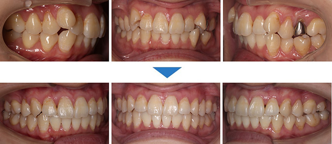 治療期間：7ヶ月（マウスピース28枚）抜歯あり