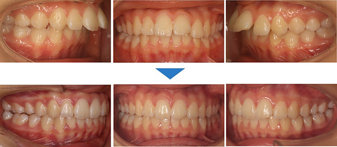 治療期間：1年6ヶ月（マウスピース65枚）抜歯なし
