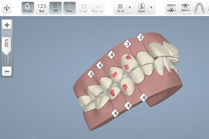 歯の動きの確認が可能