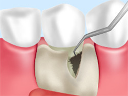 歯周外科手術