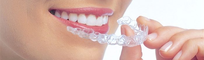 invisalign_1[1]